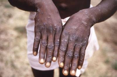 WHO declares mpox outbreak a global health emergency